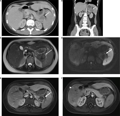 Co-occurrence of VHL and SDHA Pathogenic Variants: A Case Report